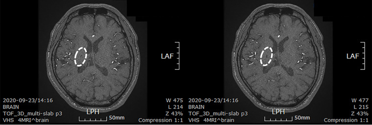 圖4：微創人臍帶間充質干細胞移植后患者的腦部計算機斷層掃描圖像。