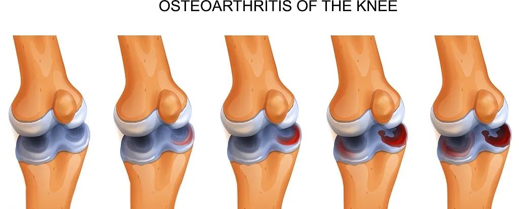 國(guó)內(nèi)外臨床研究表明：干細(xì)胞修復(fù)半月板損傷更具優(yōu)勢(shì)