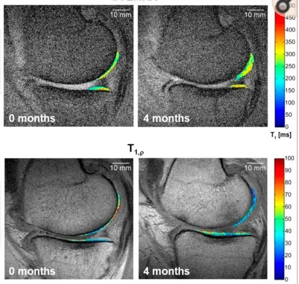 干細(xì)胞療法修復(fù)后疼痛顯著減輕，半月板軟骨質(zhì)量提高。