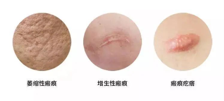 根據瘢痕的顏色、質地和形態，臨床可以將瘢痕分為三大類：萎縮性瘢痕、增生性瘢痕和瘢痕疙瘩。