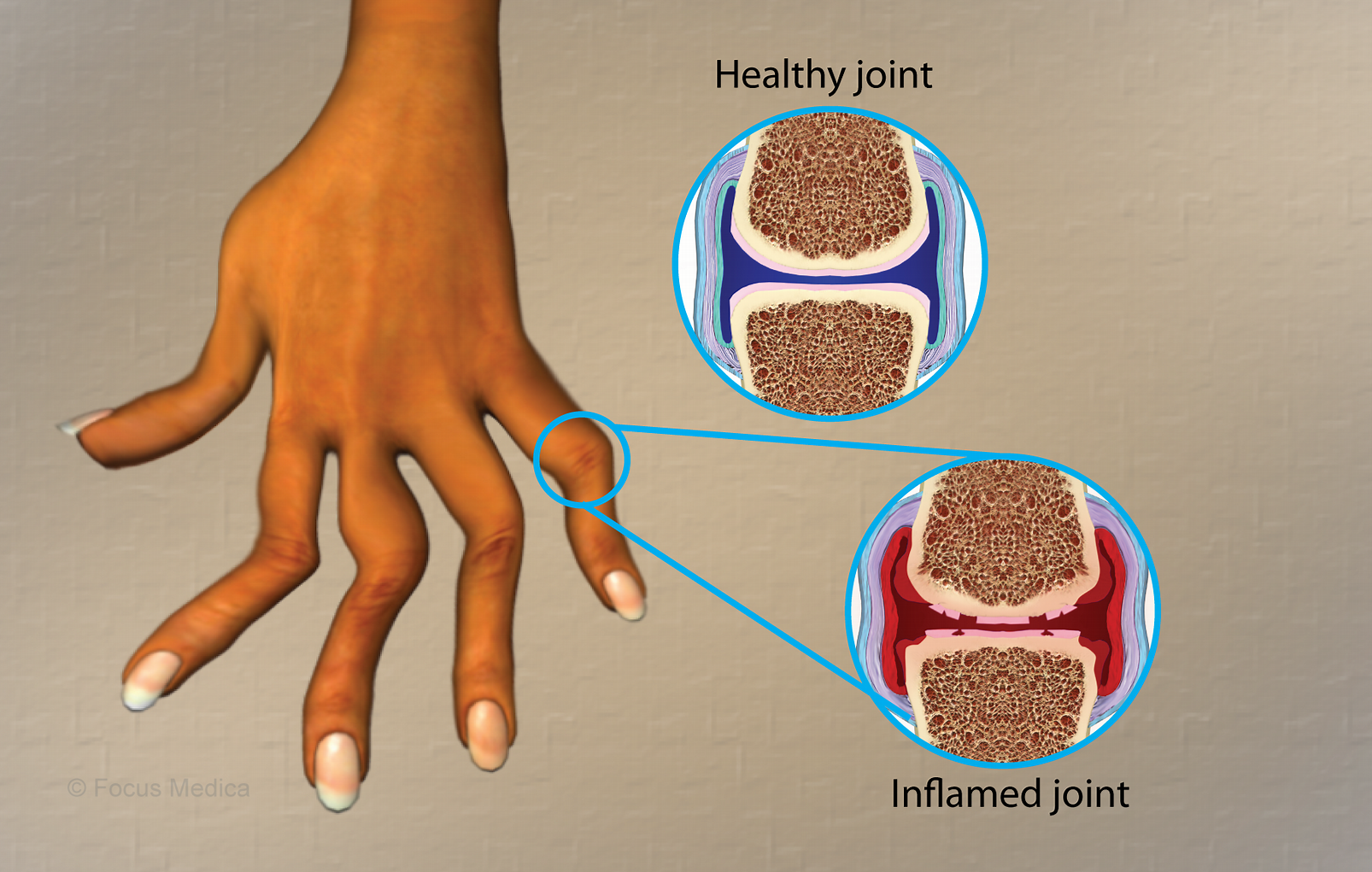 類風濕關節炎是什么病 類風濕關節炎是什么病