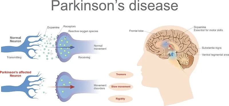 什么是帕金森病的再生醫學 什么是帕金森病的再生醫學