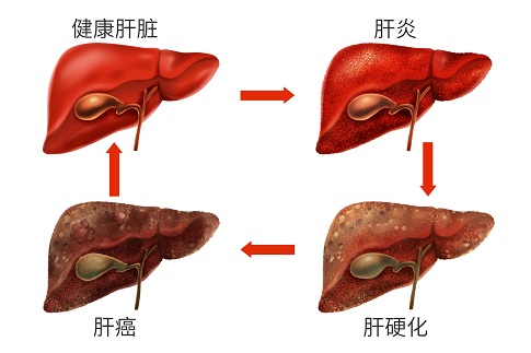 人臍帶血間充質干細胞移植治療失代償性肝硬化患者