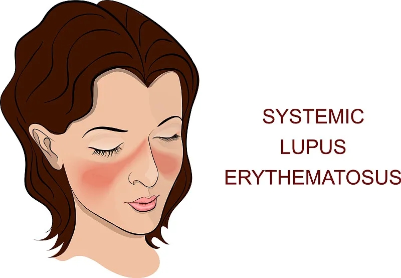 系統性紅斑狼瘡是一種自身免疫性疾病，其特征在于針對細胞核和細胞質抗原的自身抗體