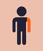 單癱型腦癱影響一側(cè)肢體,通常是手臂。 單癱型腦癱影響一側(cè)肢體,通常是手臂。