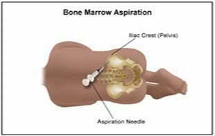 從骨髓中分離干細胞