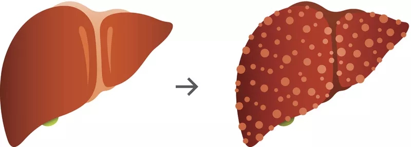 肝硬化的體征和癥狀是什么？及其治療方法