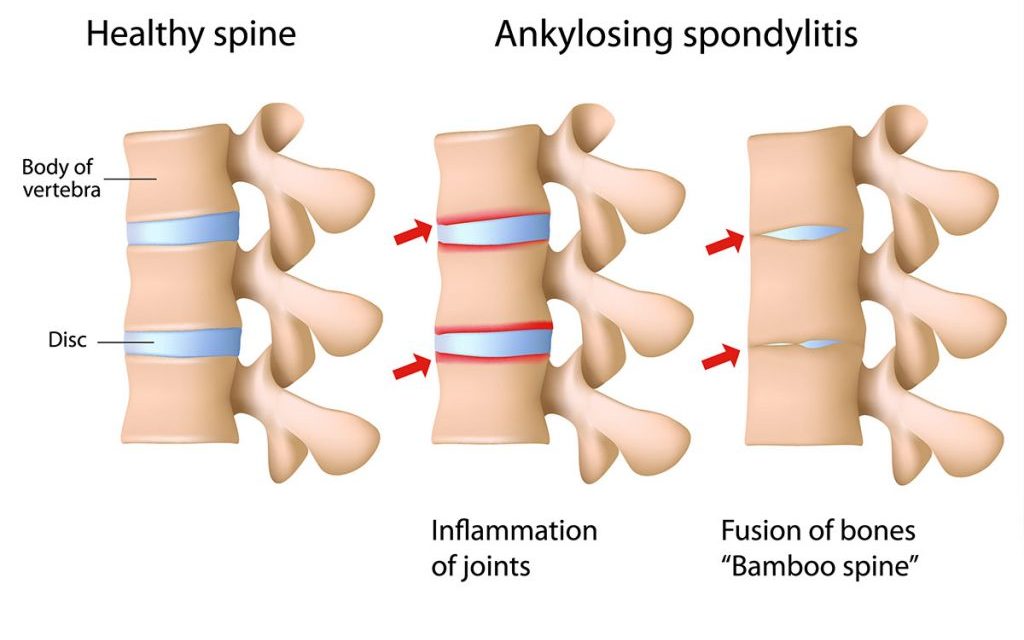 間充質干細胞療法與強直性脊柱炎：一種新的治療方法