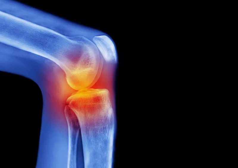 骨關節炎——間充質干細胞在軟骨再生中的作用