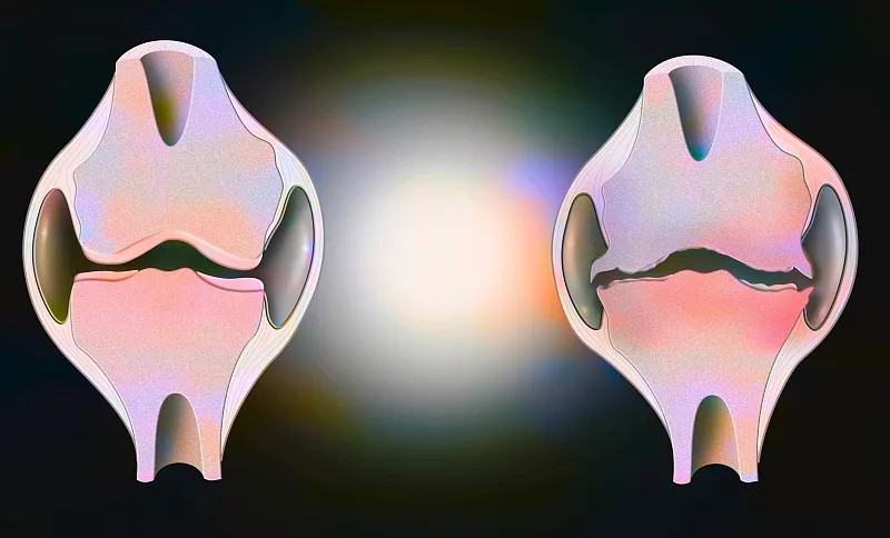 盤點(diǎn):2020~2023年干細(xì)胞治療骨關(guān)節(jié)炎的臨床研究進(jìn)展 盤點(diǎn):2020~2023年干細(xì)胞治療骨關(guān)節(jié)炎的臨床研究進(jìn)展