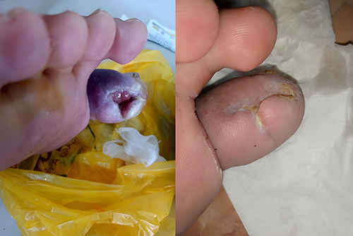 圖4：糖尿病潰瘍修復示例–干預前（左）和干預后（右）。