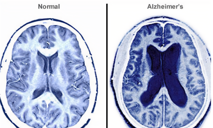 干細(xì)胞治療阿爾茲海默癥機(jī)制分2種途徑
