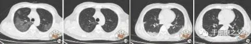 細胞輸注后，炎癥指標改善，復查胸部CT提示雙肺病灶較前吸收，呼吸道癥狀改善，新型冠狀病毒核酸檢測連續2次陰性，治愈出院。