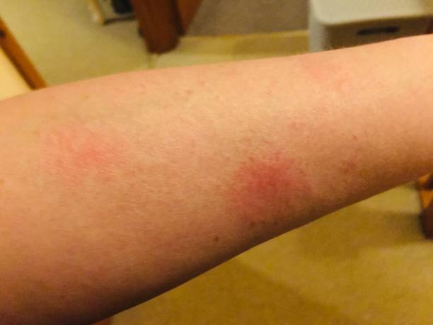 系統(tǒng)性紅斑狼瘡的最佳治療方法是什么？