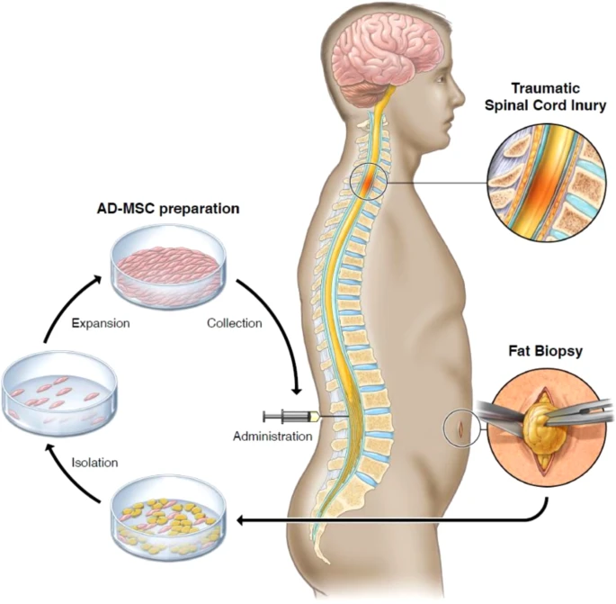 通過活檢、AD-MSC 分離、擴增和收集以及治療管理來獲取脂肪的過程圖解