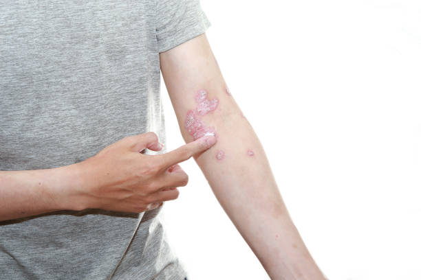 預防銀屑病發作的10個技巧，你都了解嗎？