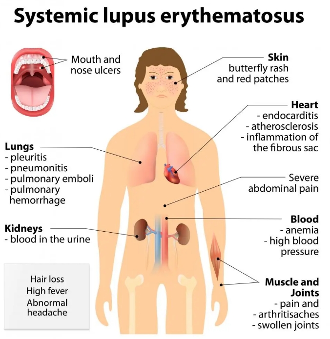 什么是系統性紅斑狼瘡？干細胞治療系統性紅斑狼瘡的臨床案例有哪些?