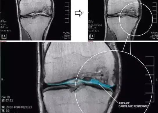 干細胞治療膝骨關節炎臨床案例 干細胞治療膝骨關節炎臨床案例