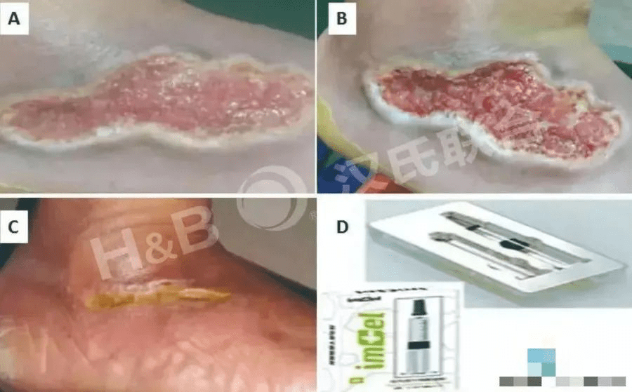 糖尿病足潰瘍患者使用胎盤(pán)衍生間充質(zhì)干細(xì)胞水凝膠進(jìn)行三周局部治療：病例報(bào)告。