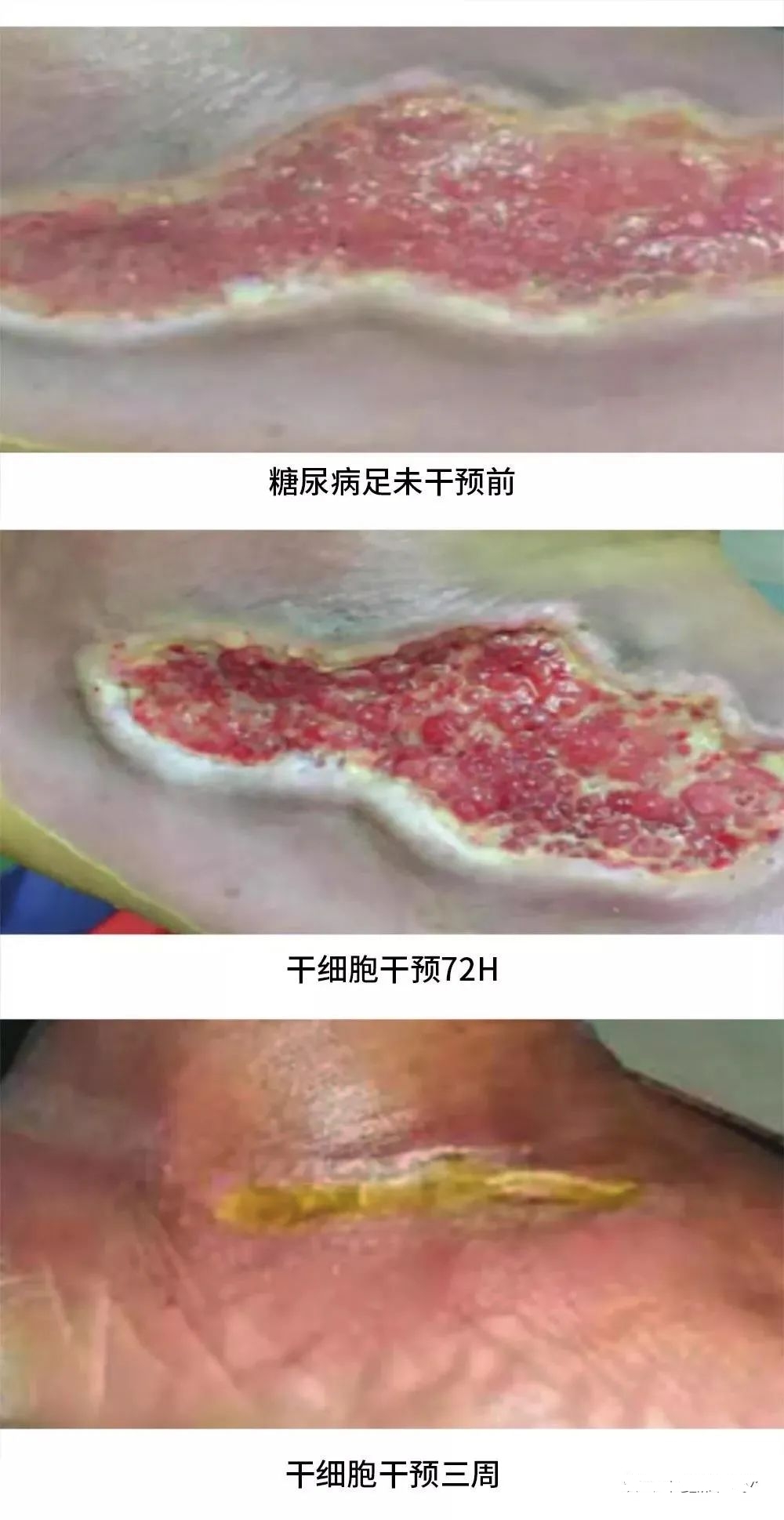 患者治療72小時化膿性分泌物和傷口大小明顯減少，3周后足部潰瘍幾乎愈合，足部行走功能也得到了恢復。