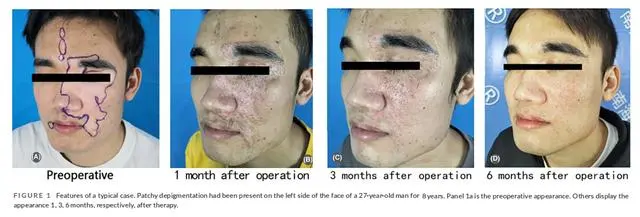 2023年干細(xì)胞治療白癜風(fēng)臨床案例