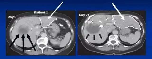 干細胞治療肝硬化的治療效果如何？