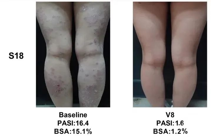 總共47.1% (8/17)的銀屑病患者在PASI（皮損面積和嚴重程度）評分中有至少40%的改善