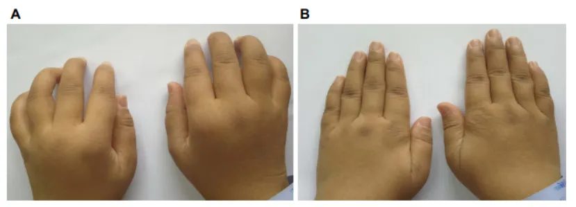 33歲女性，患病4年，治療前后對比