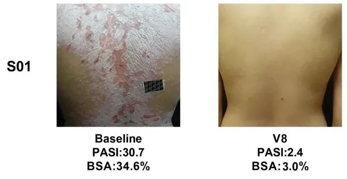 同種異體UMSCs的移植對(duì)銀屑病患者安全且部分有效，尤其對(duì)女性銀屑病患者