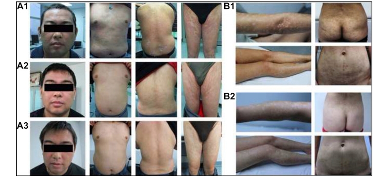 兩例尋常型銀屑病患者通過(guò)臍帶間充質(zhì)干細(xì)胞（UC-MSCs）治療，兩例患者均在4至5年內(nèi)未復(fù)發(fā)。
