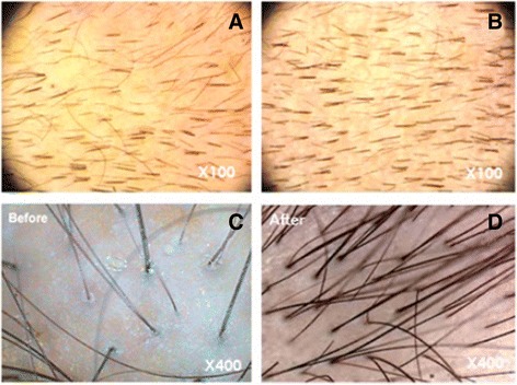 圖3：記錄脂肪干細(xì)胞療法后頭發(fā)數(shù)量增加的照片。移植前（ac）和移植后6個(gè)月（bd）頭皮的代表性圖像