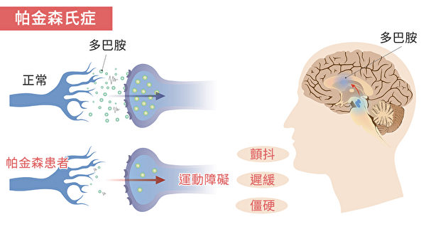 帕金森病 (PD) 的常見癥狀
