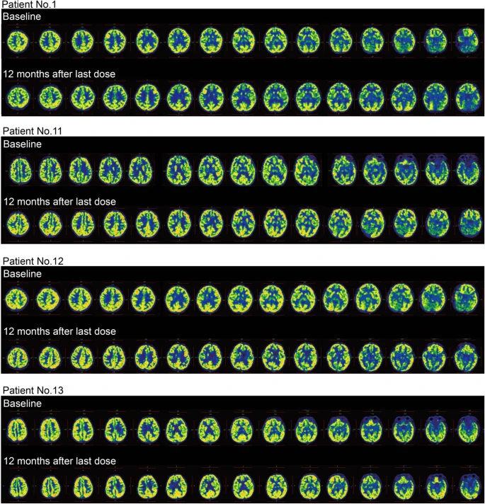 圖4：干預后腦代謝變化。