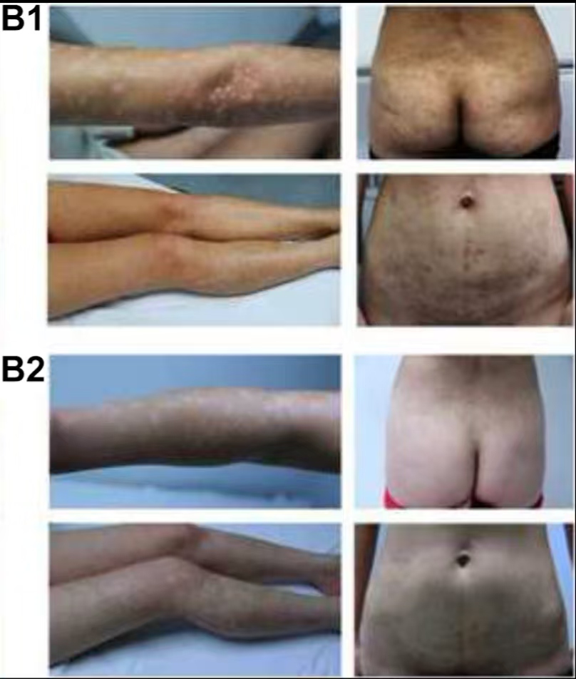 （圖B1）患者入院后體檢發(fā)現(xiàn)，患者全身遍布橙紅色斑塊，上面覆有銀色鱗屑

（圖B2）治療初期，我院給予患者3次臍帶間充質(zhì)干細(xì)胞，連續(xù)3周回輸，患者全身表面逐漸恢復(fù)光滑