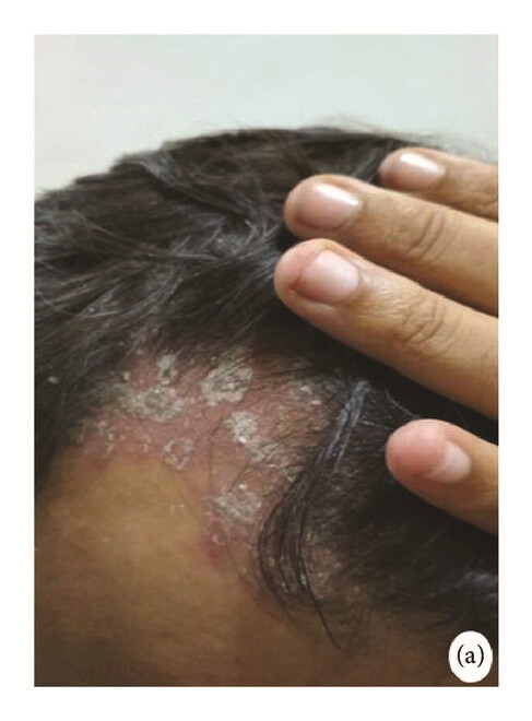 骨髓間充質(zhì)干細(xì)胞 治療前，患者頭皮上出現(xiàn)大量紅斑，并附著銀色鱗片（a）。