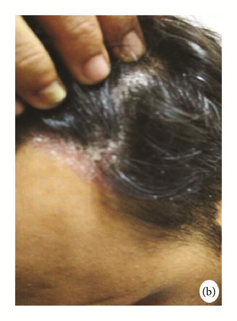 骨髓間充質(zhì)干細(xì)胞 治療前，患者頭皮上出現(xiàn)大量紅斑，并附著銀色鱗片（b）。