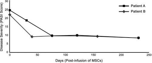 圖 1?. 移植 MSCs 前后兩例患者的銀屑病面積和嚴(yán)重程度指數(shù) (PASI) 評分總結(jié)。在輸注 MSCs 后的隨訪中，每例患者的 PASI 評分均有所下降。評分由第三方皮膚科醫(yī)生進行。臨床改善持久，患者 A 的改善持續(xù)超過 150 天，患者 B 的改善持續(xù)超過 200 天。