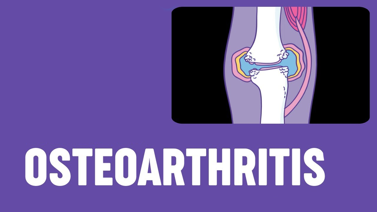 5項研究171例患者,評估干細胞治療骨關節炎的安全性和有效性 5項研究171例患者,評估干細胞治療骨關節炎的安全性和有效性