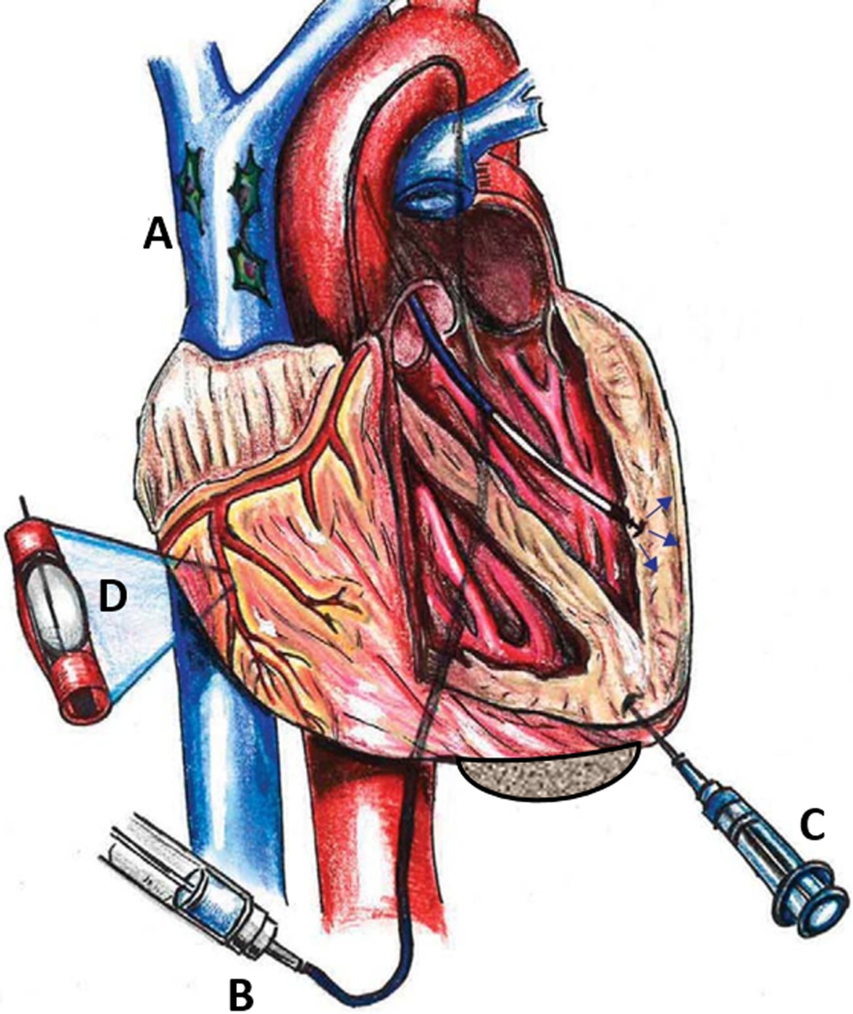 圖1：MSC通過系統 (Sys) 和局部 (Loc) 途徑進入心臟。