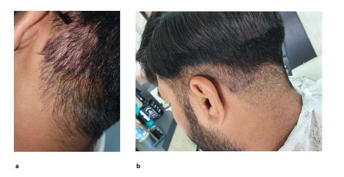 圖2.患者枕部頭皮銀屑病治療后圖像2周(a)和4周(b)頭皮銀屑病治療后鱗屑和斑塊減少的隨訪圖像。