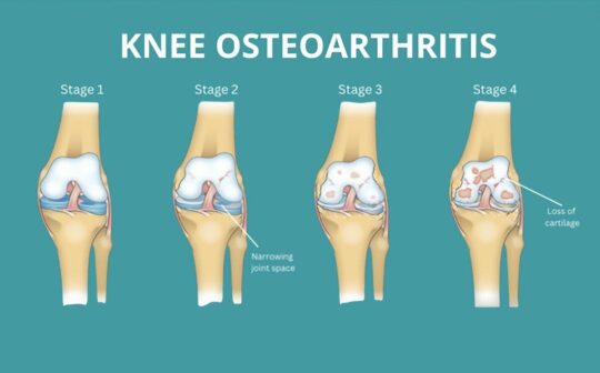干細胞治療膝骨關節炎：患者臨床癥狀顯著改善，減少炎癥，消除疼痛