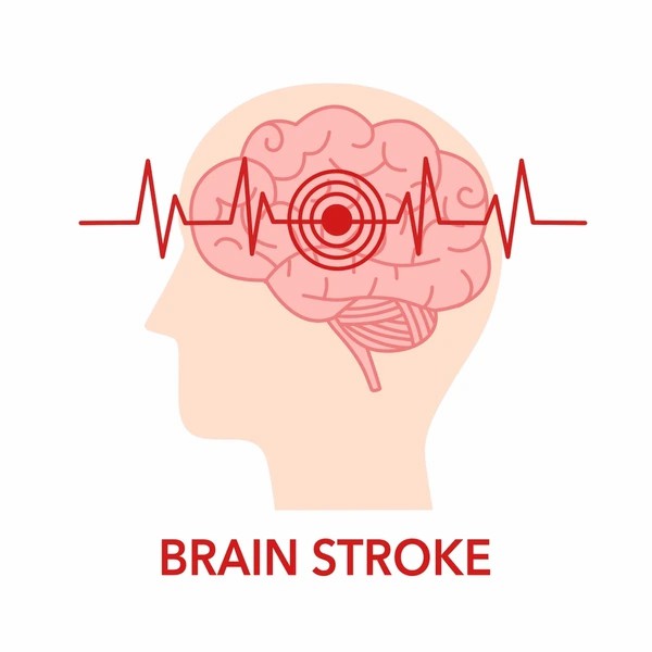 直擊腦卒中：神經干細胞移植的治療方法有哪些？
