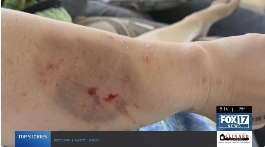 在接受干細(xì)胞治療前表現(xiàn)出嚴(yán)重的自閉癥癥狀，甚至曾咬傷母親安吉拉，留下了永久的疤痕