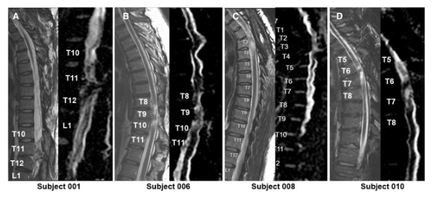MRI頸胸T2矢狀圖和AvDC矢狀圖