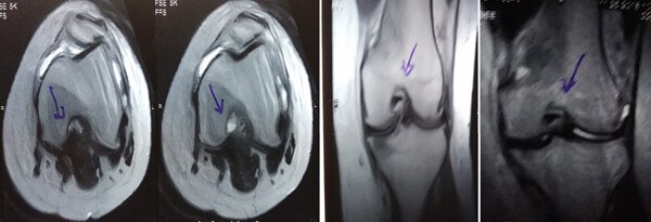 治療前 MRI 顯示內(nèi)側(cè)和外側(cè)半月板后角 III 級撕裂。
