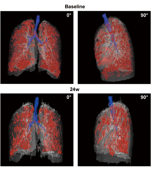 患者 #2902 自體 P63 細胞移植前和后 24 周連續肺部 CT 圖像的三維可視化。