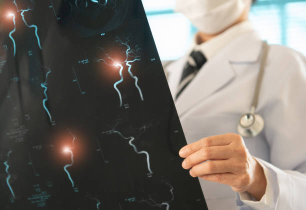 骨髓干細胞治療缺血性卒中靠譜嗎？網絡薈萃分析給出答案