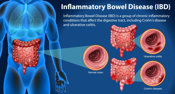 干細胞終結炎癥性腸病？8大問題解答揭秘細胞療法如何改寫治療規則