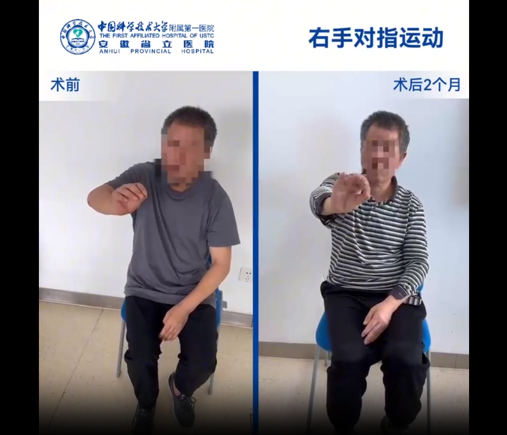 國內(nèi)誘導(dǎo)多能干細(xì)胞療法新突破：首例早發(fā)型帕金森病成功給藥，當(dāng)天即可行走