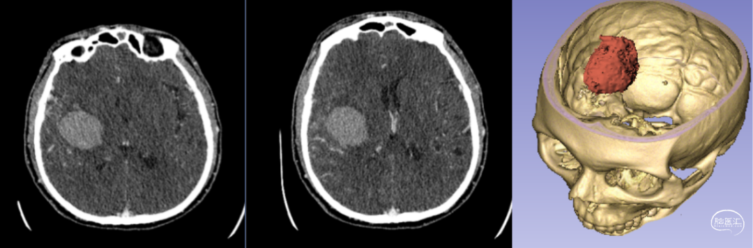 神經外科手術機器人輔助下腦內血腫穿刺術